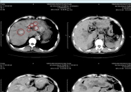 患者经胆道探查术+输尿管镜气压弹道碎石术前后胆管内结石对比图